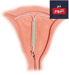 اللولب الهرموني - IUS (intrauterine system)