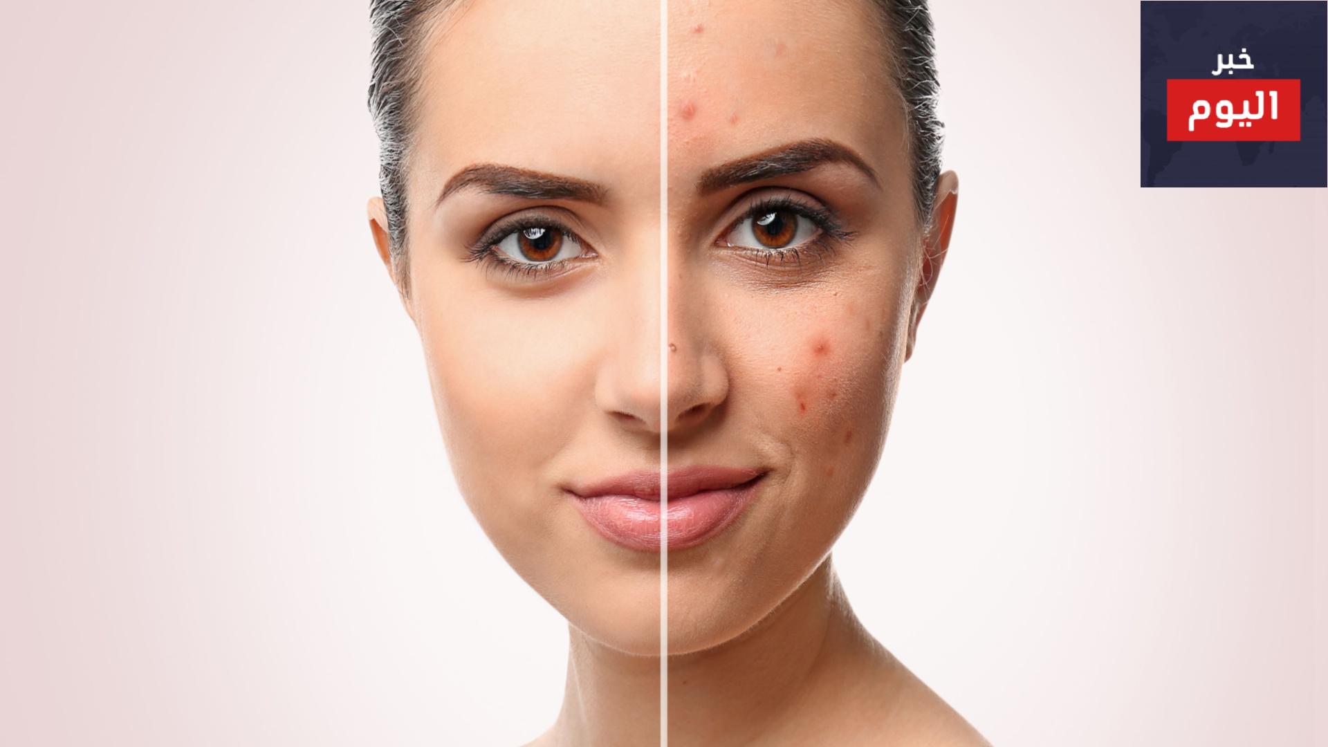 التعامل مع حب الشباب - Dealing with Acne