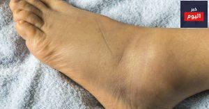 تورم القدمين في الحمل - Swollen ankles, feet and fingers