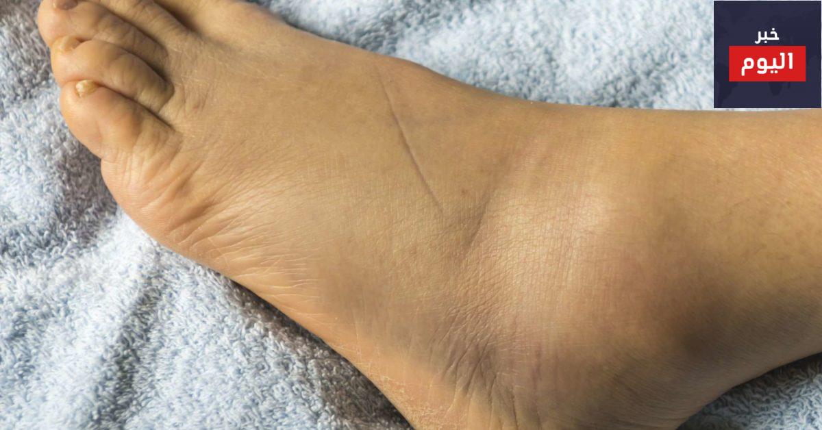 تورم القدمين في الحمل - Swollen ankles, feet and fingers