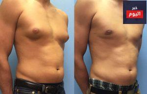 تصغير الثدي لدى الذكور - Male breast reduction