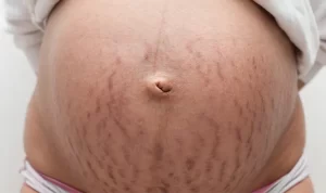 تمدد الجلد وتشققات الحمل - Stretch marks in pregnancy تمدد الجلد وتشققات الحمل - Stretch marks in pregnancy