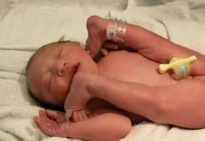 الولادة مع وضع الجنين المقعدي - Breech birth