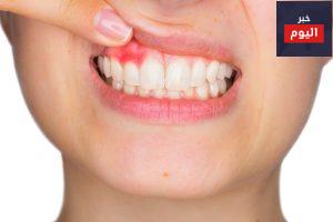التهاب اللثة وألم الأسنان في الحمل - Teeth and gums in pregnancy