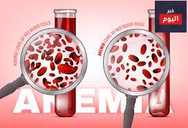 فقر الدم، نقص الحديد - Anaemia, Iron deficiency