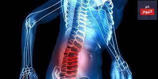 هشاشة العظام - Osteoarthritis