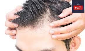 صلع الذكورالنمطي - Male pattern baldness