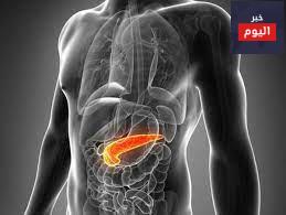 التهاب البنكرياس الحاد - Acute pancreatitis