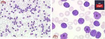 ابيضاض الدم الليمفاوي المزمن - Chronic lymphocytic leukaemia