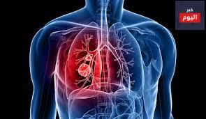 سرطان الرئة - Lung Cancer