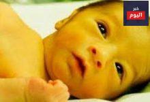 اليرقان عند حديثي الولادة - Newborn jaundice