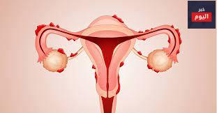 الانتباذ البطاني الرحمي - Endometriosis