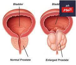 تضخُّم البروستات الحميد - BPH