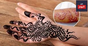 مخاطر الحناء السوداء - Dangers of black henna