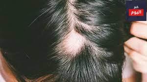 الثعلبة/تساقط الشعر - Alopecia/hair loss