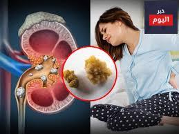 حصيّات الكلية - Kidney stones