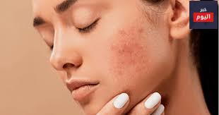 الحالات الجلدية الشائعة - Common skin conditions