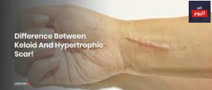 ندبات الجدرة والندبات المتضخمة - Keloid scars and hypertrophic scars