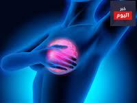سرطان الثدي عند الأنثى - Breast Cancer