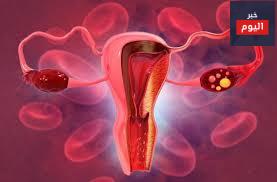 سرطان المبيض - Ovarian Cancer