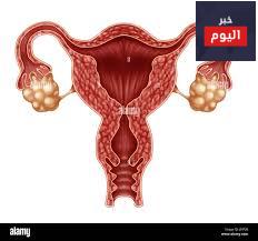 الحمل خارج الرحم - Ectopic Pregnancy
