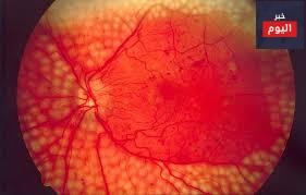 اعتلال الشبكية السكري - Diabetic retinopathy