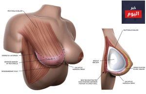 كيفية إجراء جراحة تكبير الصدر - How breast implant surgery is performed