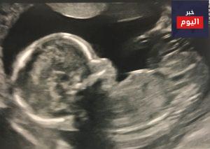 تصوير الجنين بالأمواج فوق الصوتية أثناء الحمل - Ultrasound baby scans in pregnancy