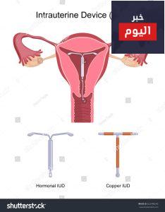 اللولب (الجهاز داخل الرحم) - IUD (intrauterine device)