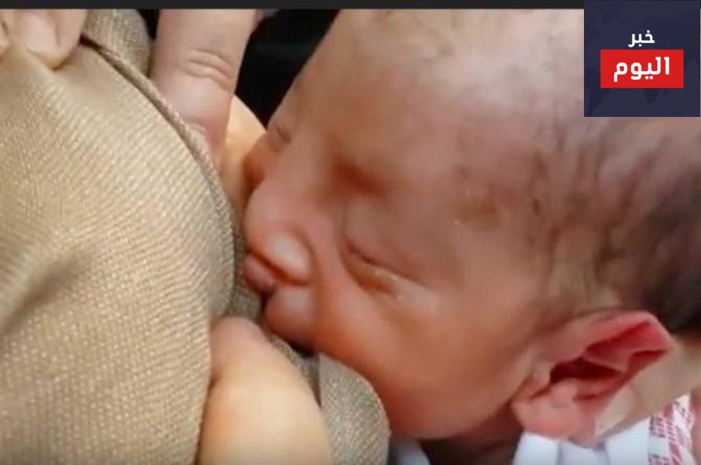 كيف يرضع المولود بشفة أرنبية رضاعة طبيعية؟