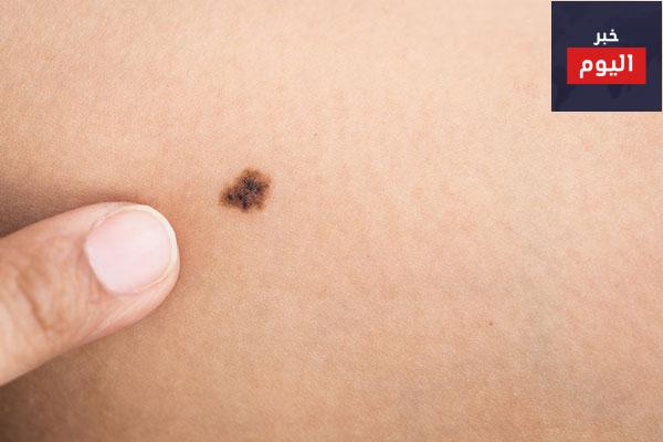 هل تتحول الشامات إلى سرطان الجلد؟