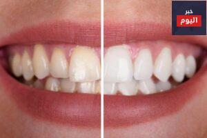طرق طبيعية لتبييض الاسنان