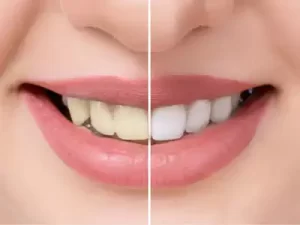 طرق تبيض الاسنان