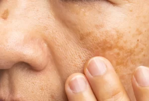 how to remove pigmentation 2