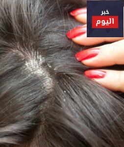 علاج قشرة الرأس وتساقط الشعر بالوصفات المنزلية