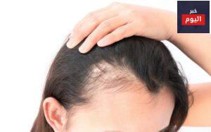 علاج تساقط الشعر للسيدات