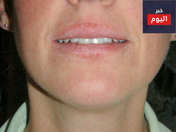 علاج جفاف الجلد حول الفم