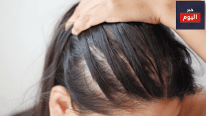 علاج تساقط الشعر للنساء مع 12 علاجًا فعال