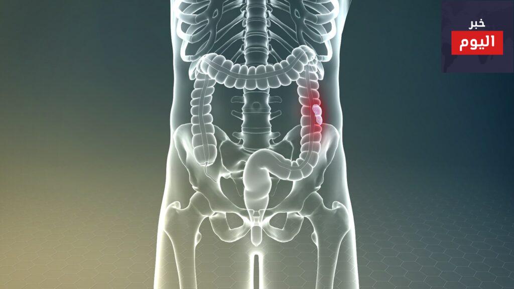 repeated-screening-colonoscopy-reduces-prevalence-of-advanced-adenoma