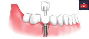 طريقة زراعة الاسنان